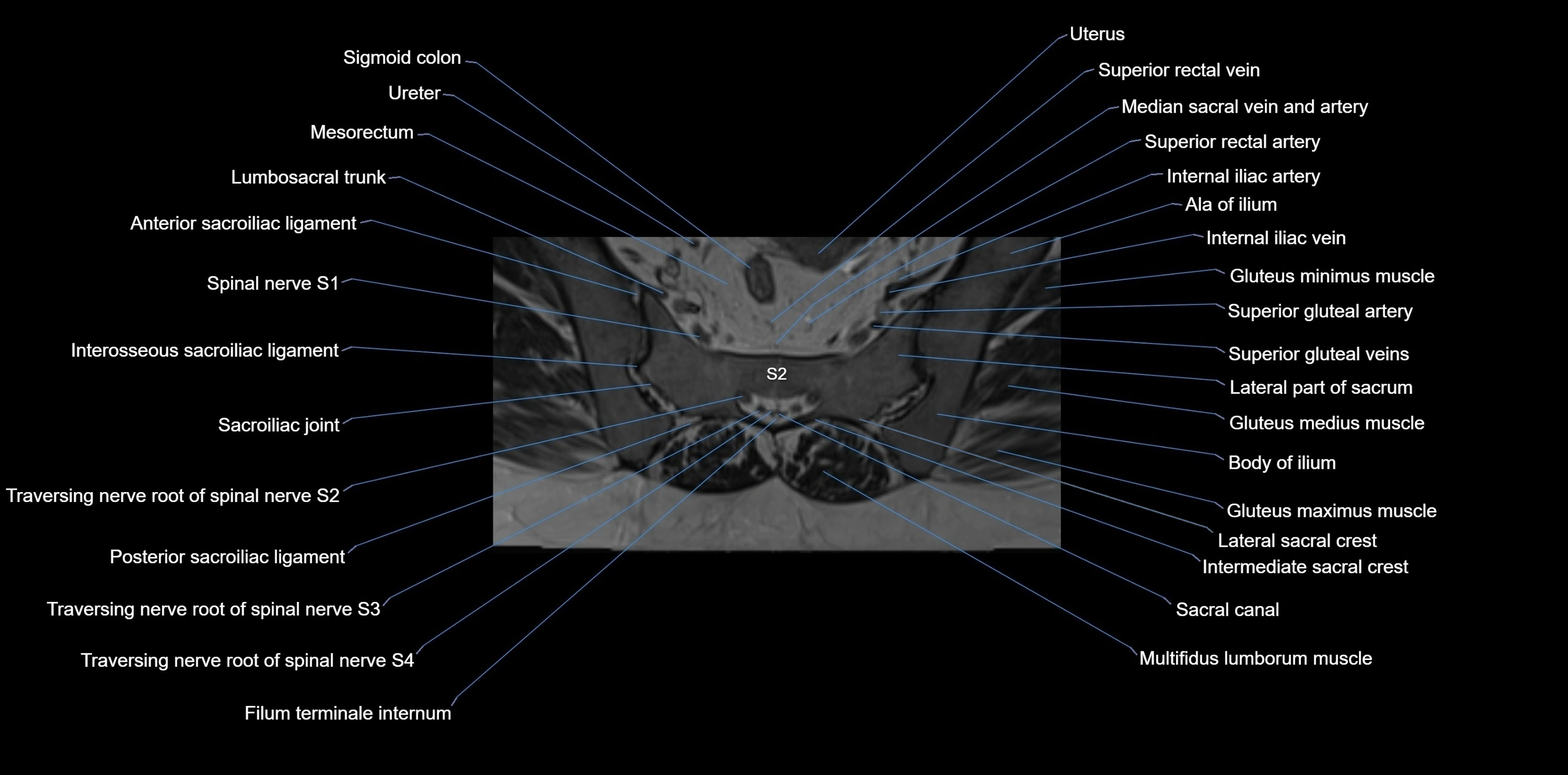 MRI sacrum, coccyx and sacroiliac joint axial cross sectional anatomy 3T  radiology  image-img-00001-00026.webp